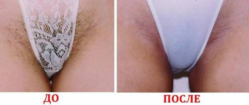шугаринг, сахарная эпиляция