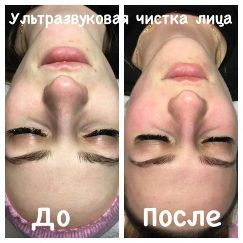 Ультрозвуковая чистка лица 