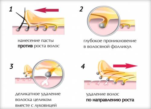 Шугаринг (сахарная депиляция)